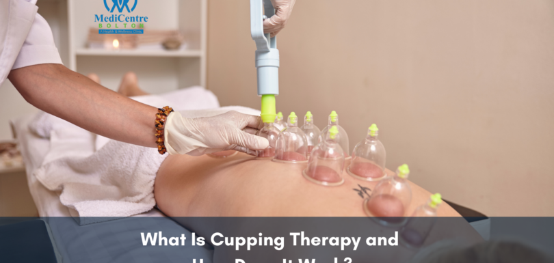 What is Cupping Therapy