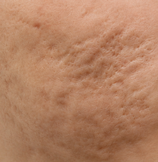 Example of a boxcar acne scar