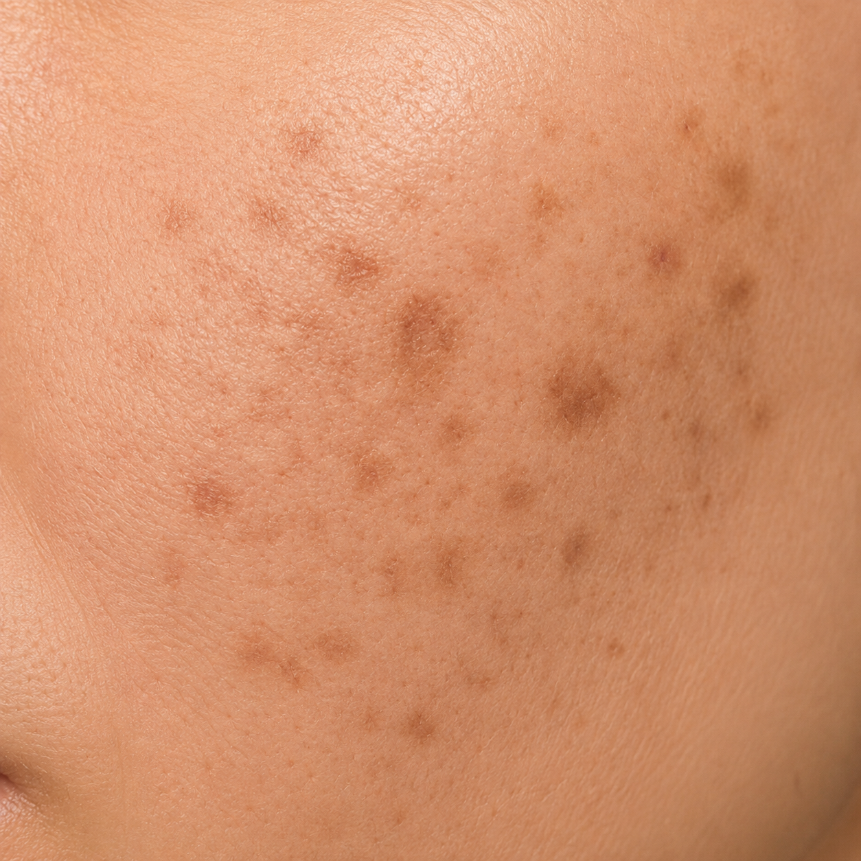 Example of post-inflammatory hyperpigmentation acne marks