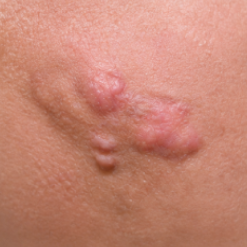 Example of a hypertrophic or keloid scar