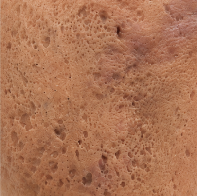 Example of an icepick acne scar