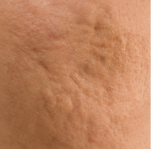 Example of a rolling acne scar